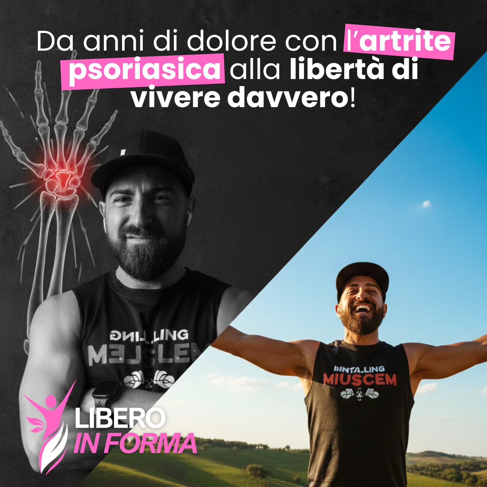 Da anni di dolore con l’artrite psoriasica alla libertà di vivere davvero: la mia storia.